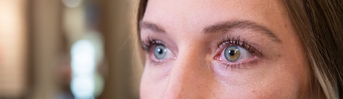 a woman with heterochromia spokane eye clinic