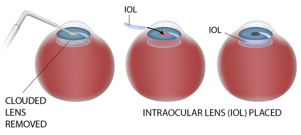 Cataract Surgery with block Post-Op Instructions (1) - North Idaho